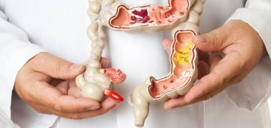 Câncer de intestino: como prevenir essa doença silenciosa e letal