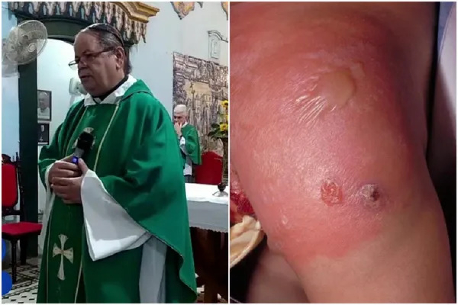 O que é erisipela bolhosa, infecção que matou o padre desaparecido em Salvador