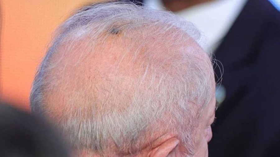 Lula passa por procedimentos médicos nesta sexta: entenda os detalhes